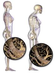 7 Steps to Help With Osteoporosis.
